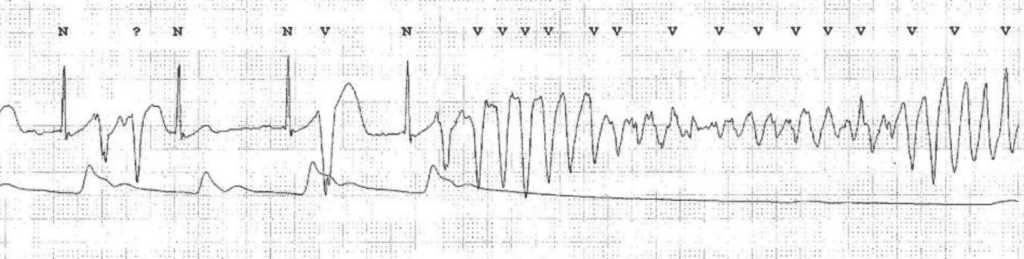 ECG showing an episode of sinus rhythm (with multiple ventricular premature beats) spontaneously converting to Torsade de Pointes ventricular tachycardia. Notice how arterial blood pressure (ABP) drops at the onset of TdP. ECG by Nakstad et al (Scand J Trauma Resusc Emerg Med. 2010; 18: 7)