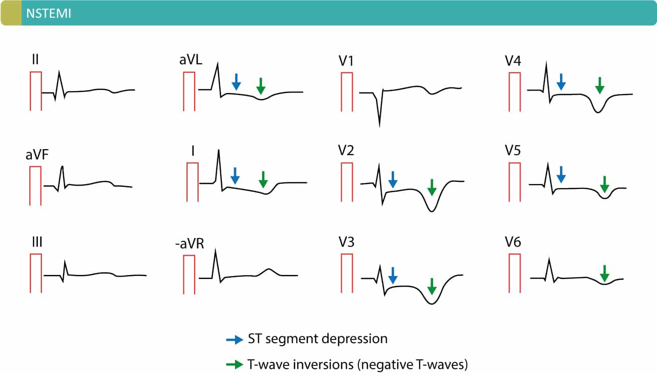 nstemi-non-st-elevation-myocardial-infarction-unstable-angina