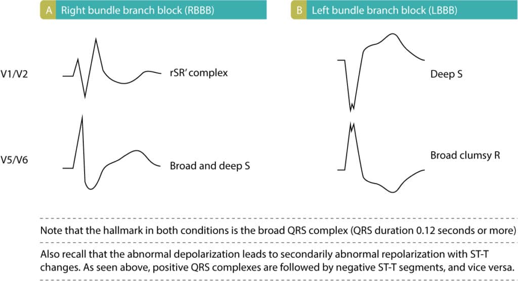 Figure 2. Characteristics of bundle branch blocks.