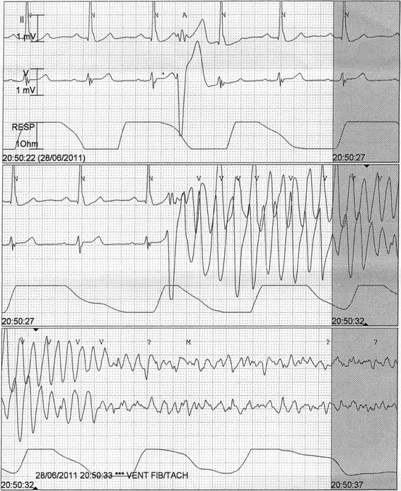 ventricular flutter vs fibrillation