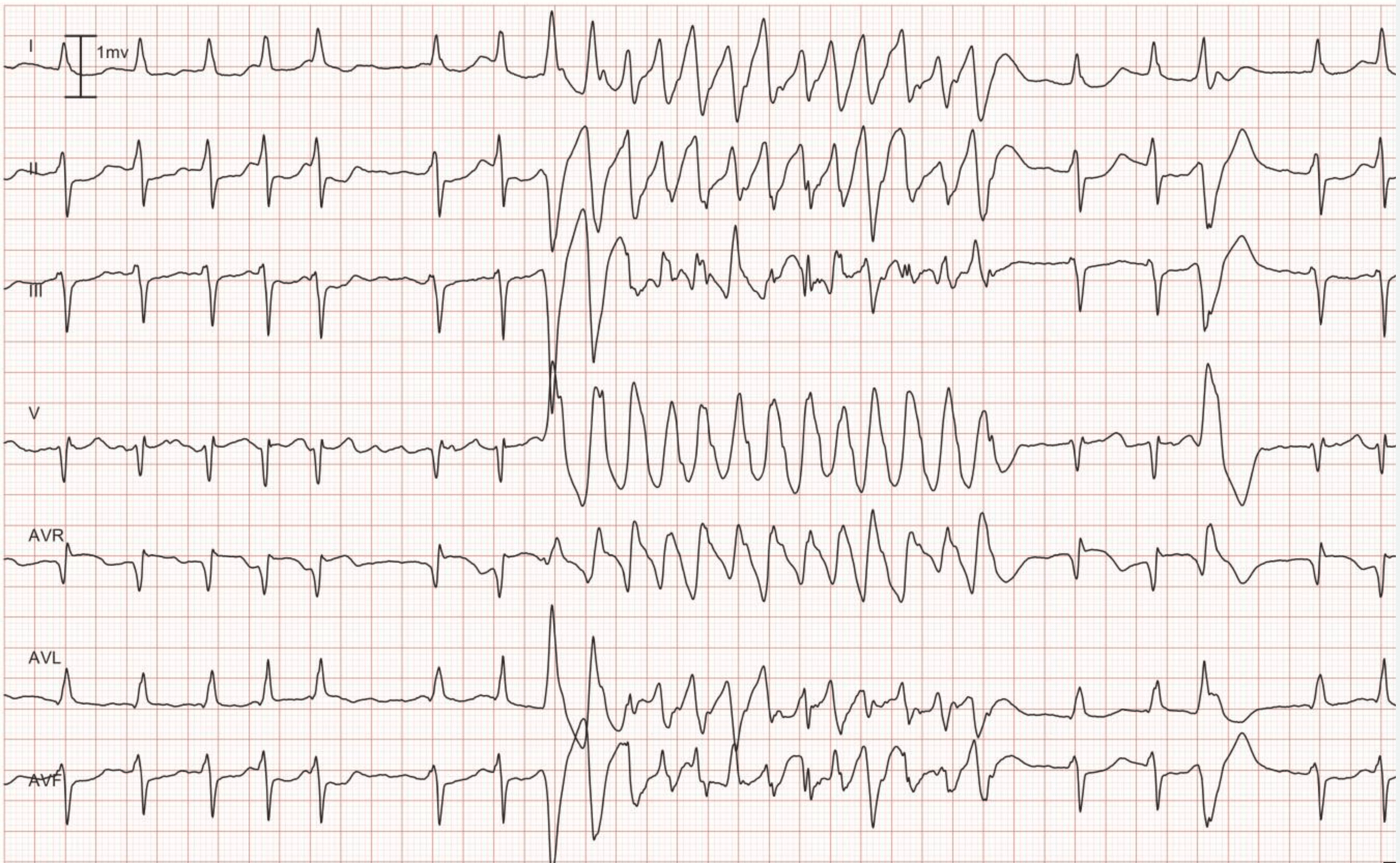 ventricular tachycardia ecg