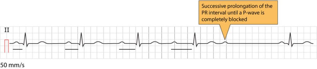 Figure 1. Second-degree AV block Mobitz type 1, also known as Wenckebach block.
