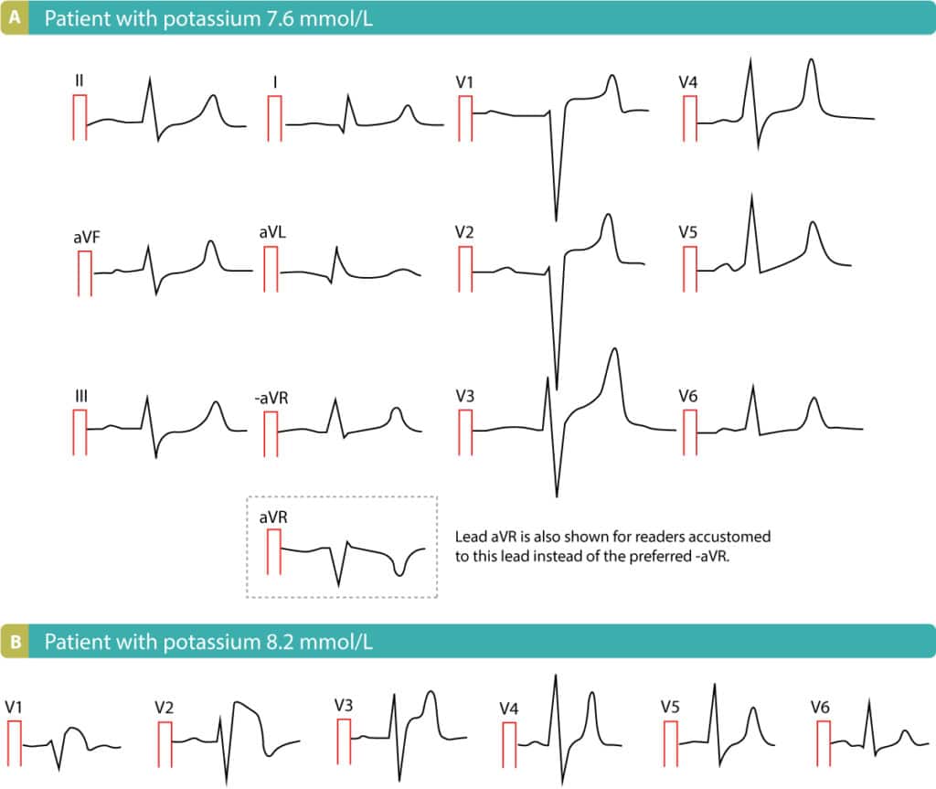 Figure 9. ST-segment elevations due to hyperkalemia. ECGs from Life in the Fast Lane.