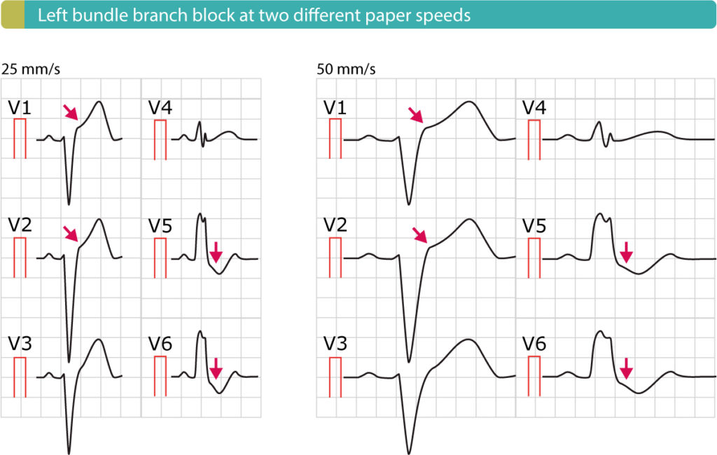 Figure 4. Left bundle branch block (LBBB).