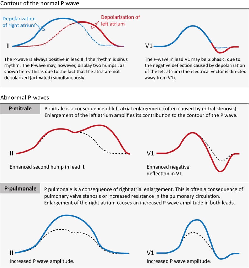 Figure 1. The contour of the normal P-wave, P mitrale and P pulmonale.
