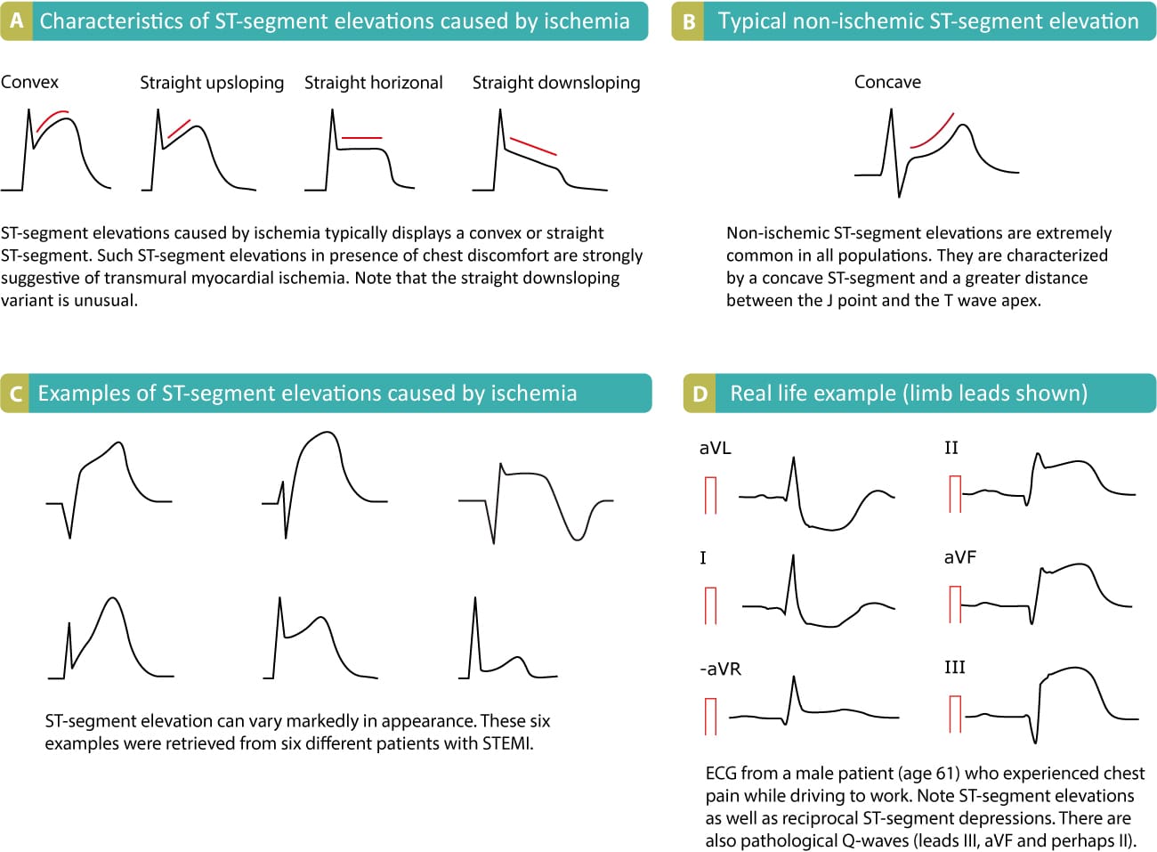 What Does Nonspecific St Elevation Mean