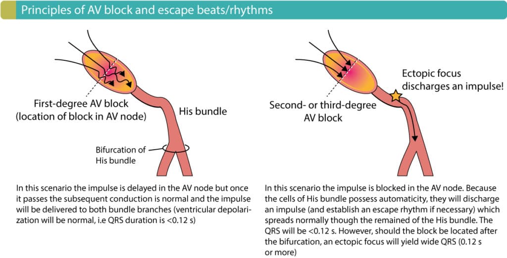 Figure 2. Principles of AV blocks.