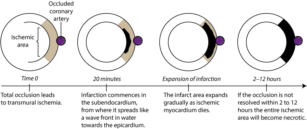 Figure 2. The natural course in total occlusions (transmural ischemia).