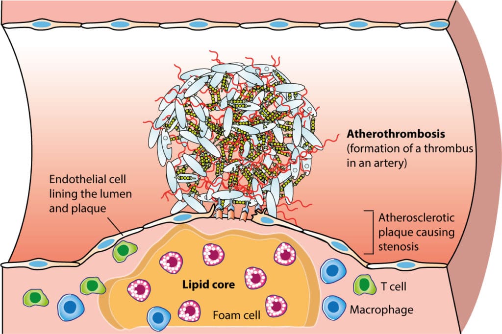 Figure 1. Atherosclerotic plaque which has ruptured and lead to atherothrombosis.