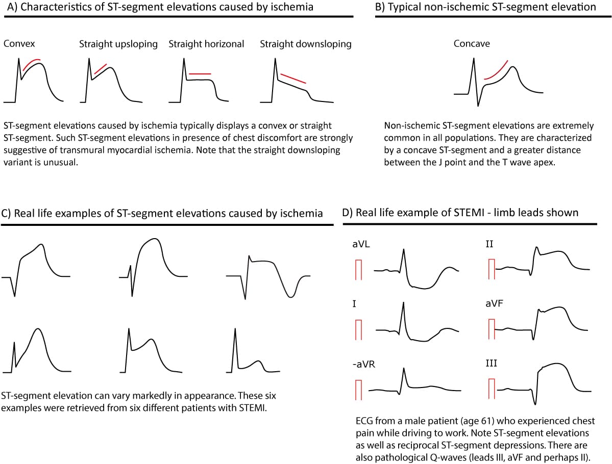 Figur 36. STsegment elevations. ECG learning