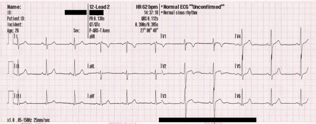 Figure 1. Traditional presentation of the leads in the 12-lead ECG.