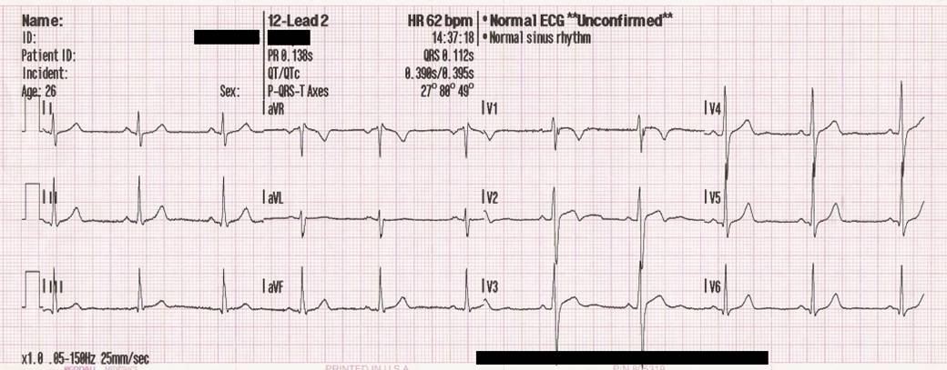 normal 12 lead ecg