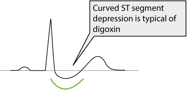 Figur 1. ST-segmentdepression på grund av digoxinbehandling.