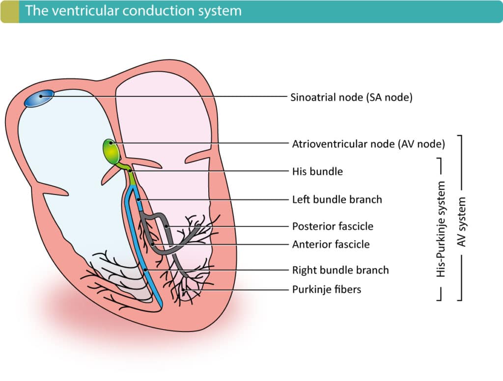 Right bundle branch block (RBBB) ECG, criteria, definitions, causes