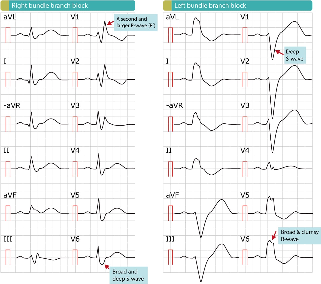 Right Bundle Branch Block RBBB ECG Criteria Definitions Causes Right Bundle Branch Block RBBB ECG Criteria Definitions Causes