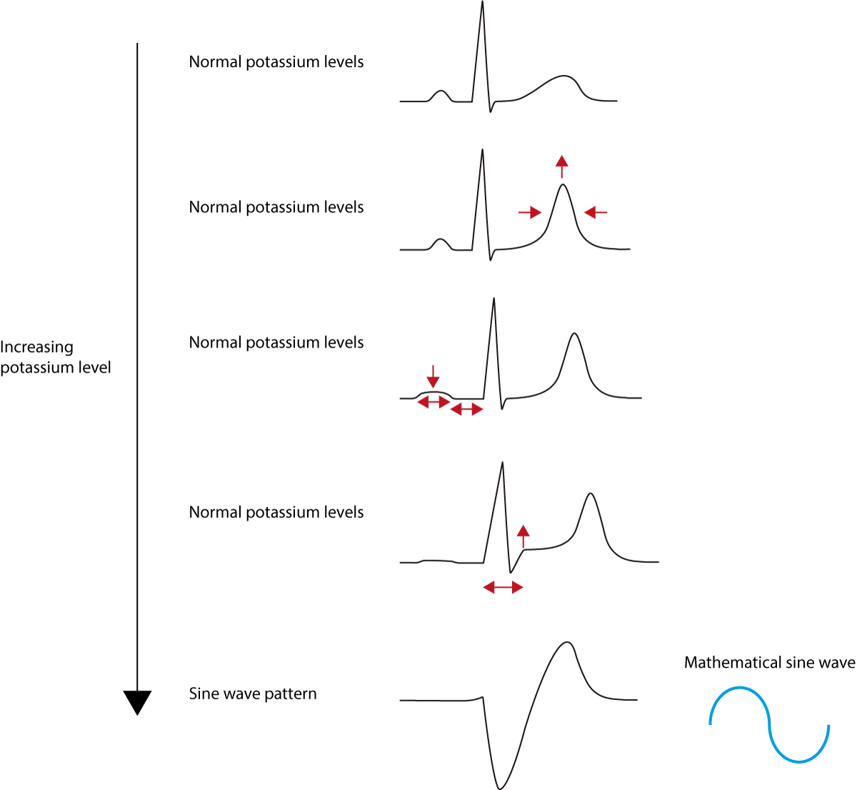 peaked t waves potassium