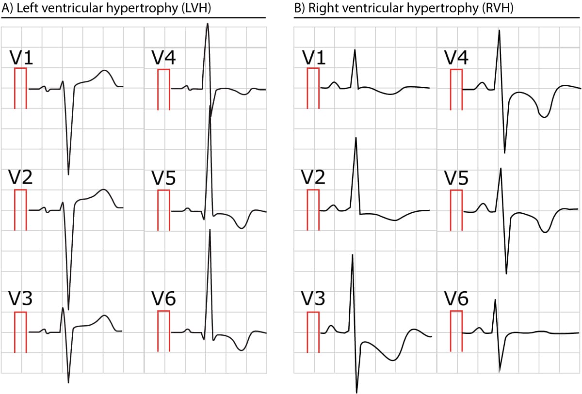 right-ventricular-hypertrophy-right-atrial-enlargement-ecg-slidesharedocs