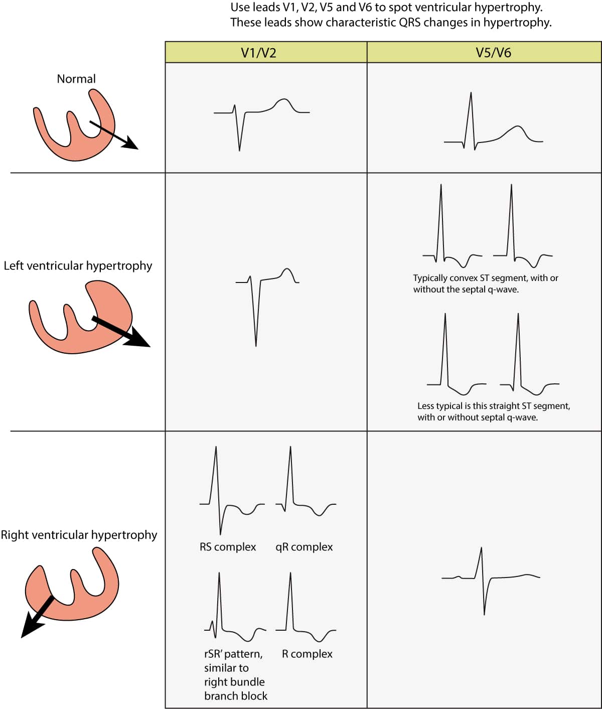 Right ventricular hypertrophy (RVH): ECG criteria ... cat 6 termination diagram explanation 