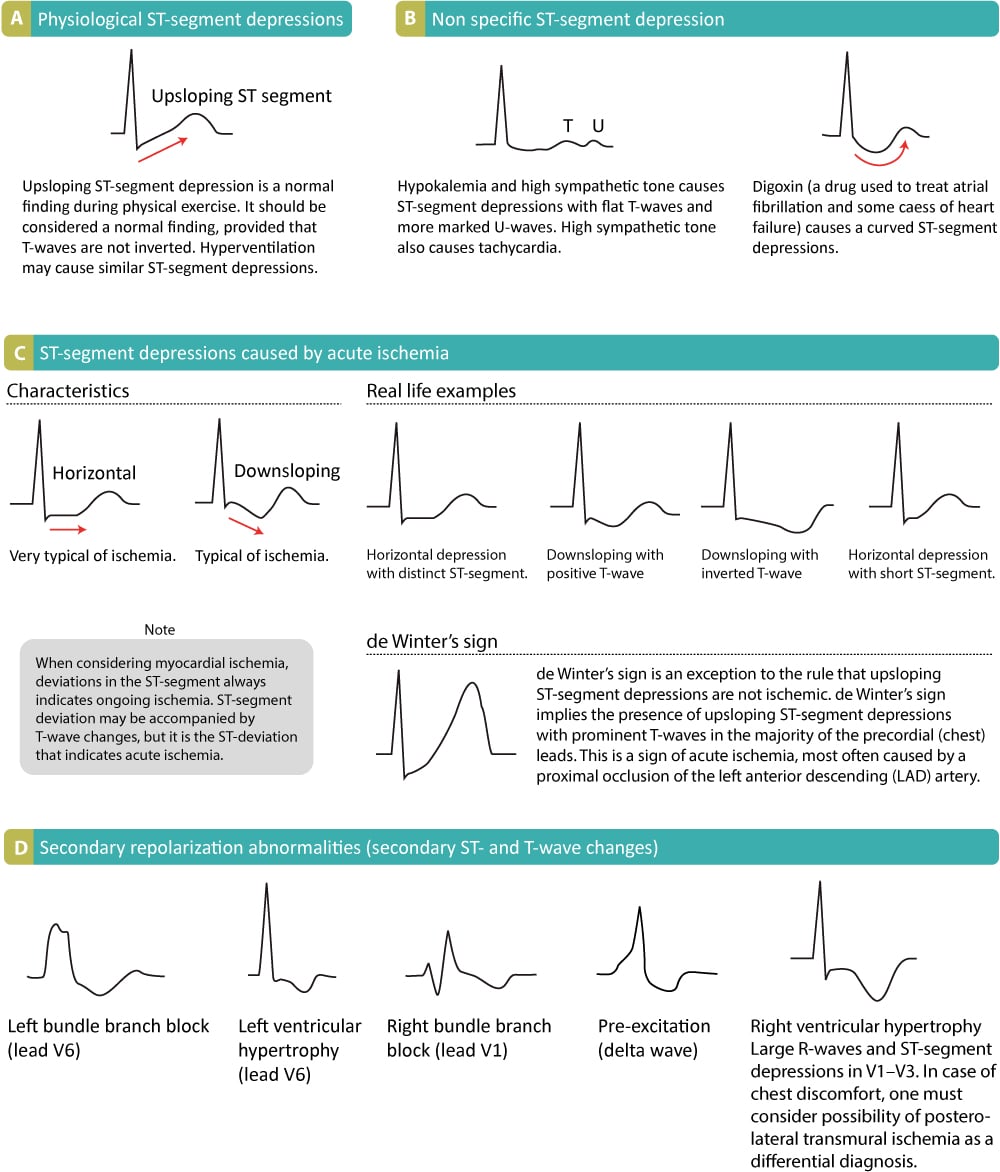 st-segment-depression-in-myocardial-ischemia-and-differential-diagnoses