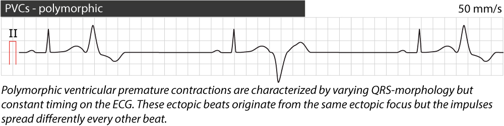 premature ventricular contraction ecg