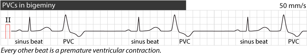 Premature Ventricular Contractions Types