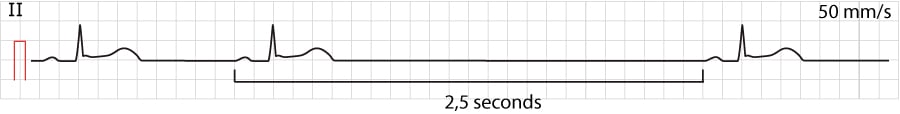 Figure 1. Sinoatrial arrest. Also note the ST-segment elevations (which in this case has no relation to the sinoatrial arrest).