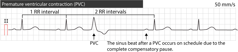 premature ventricular contractions