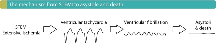 Figure 8. The progression from STEMI to asystole and death.
