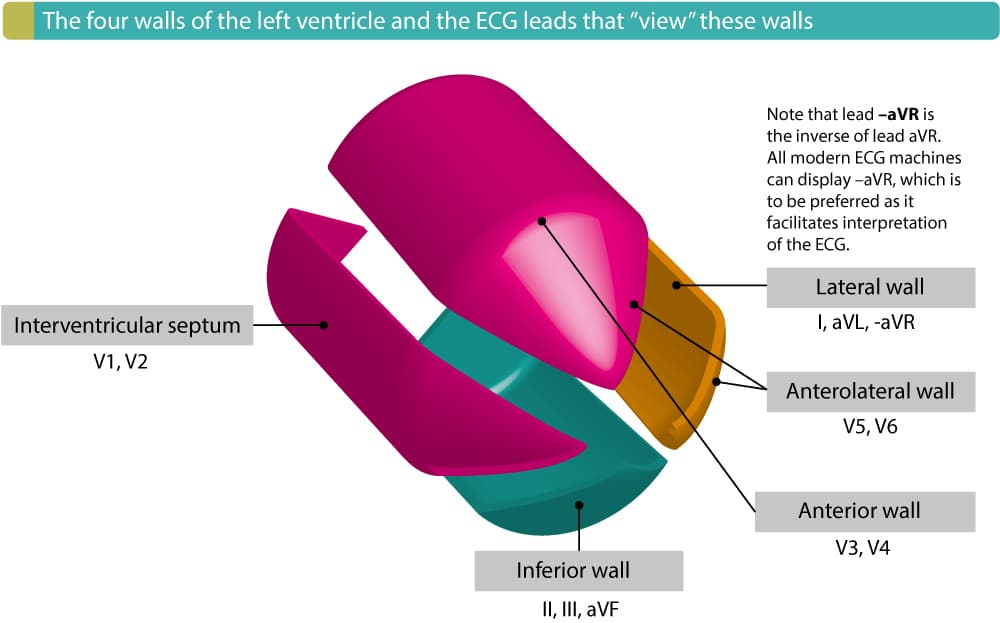 Figure 4. The four walls of the left ventricle and the ECG leads that reflect these walls. The term "contiguous leads" refers to any two leads that are anatomical neighbours. Hence, ST elevation in leads V1 and V2 would fulfill criteria for STEMI. ST elevation in V2 and V3 would also fuflfill criteria for STEMI because these two leads are also anatomical neighbours, even if this illustration shows that V2 reflects the septal wall and V3 the anterior wall.
