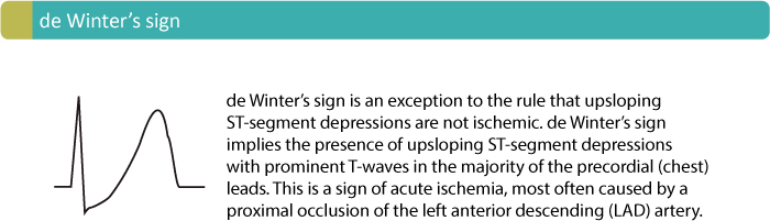 T Waves In Ischemia Hyperacute Inverted Negative Wellens Sign And De Winters Sign Ecg 0734