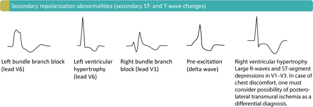 Figure 4. Secondary ST-T changes due to LBBB (left bundle branch block), LVH (left ventricular hypertrophy), RBBB (right bundle branch block), pre-ecitation (WPW syndrome) and RVH (right ventricular hypertrophy).