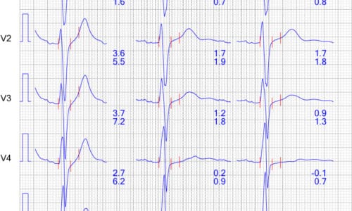Figure 10. ECG reaction in chest leads during recovery.