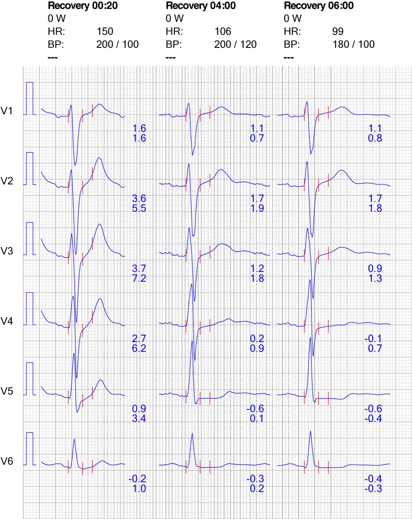 exercise-stress-test-treadmill-test-exercise-ecg-introduction-ecg