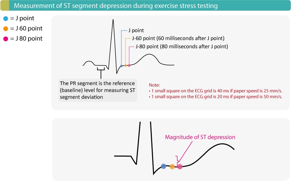 Evaluation Of Exercise Stress Test Ecg Symptoms Blood Pressure Heart Rate Performance Ecg Echo