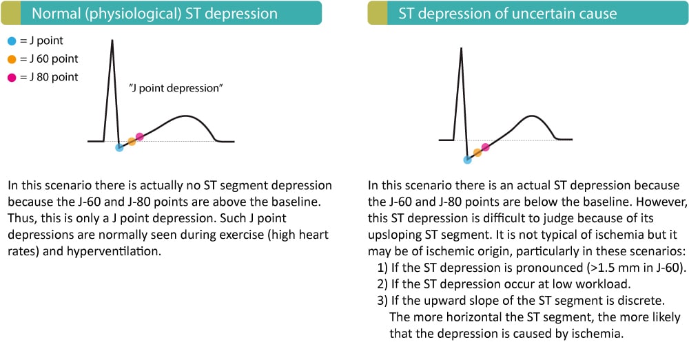 evaluation-of-exercise-stress-test-ecg-symptoms-blood-pressure