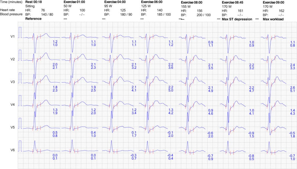 Evaluation of exercise stress test ECG, symptoms, blood pressure