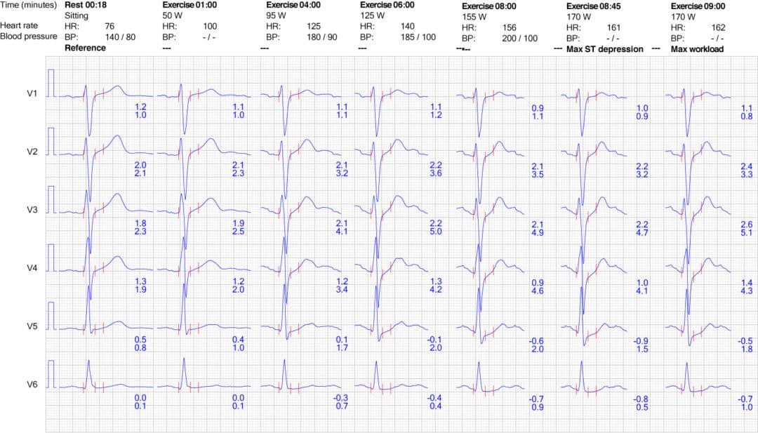 Figure 9. ECG reaction in chest leads during exercise. ECG learning