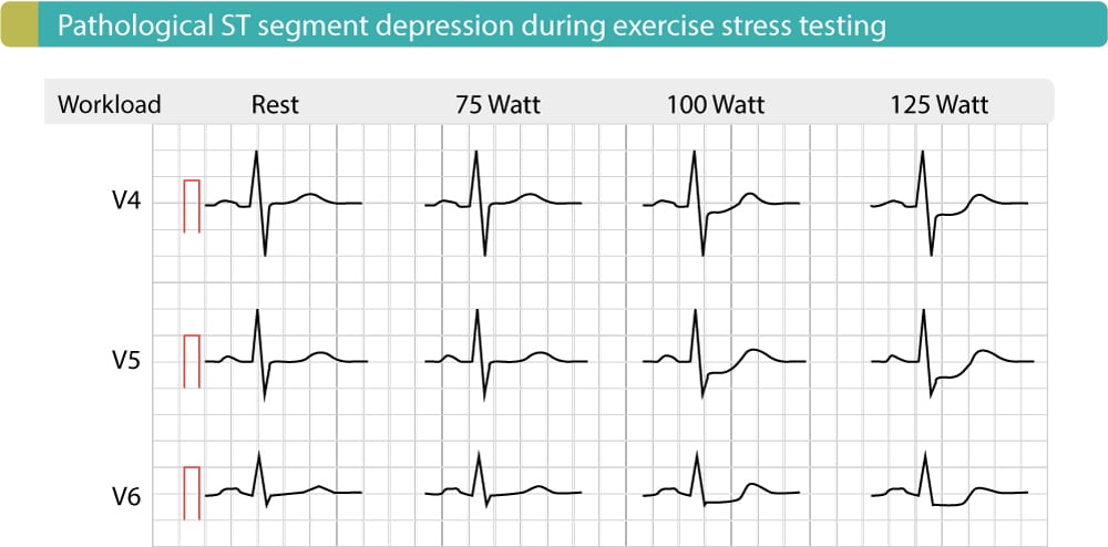 Figure 5. Exercise ECG in patient with coronary artery disease shows significant ST depressions in J-60 point, J-80 point. These depressions become more pronounced as workload increases. This test was performed on bicycle.