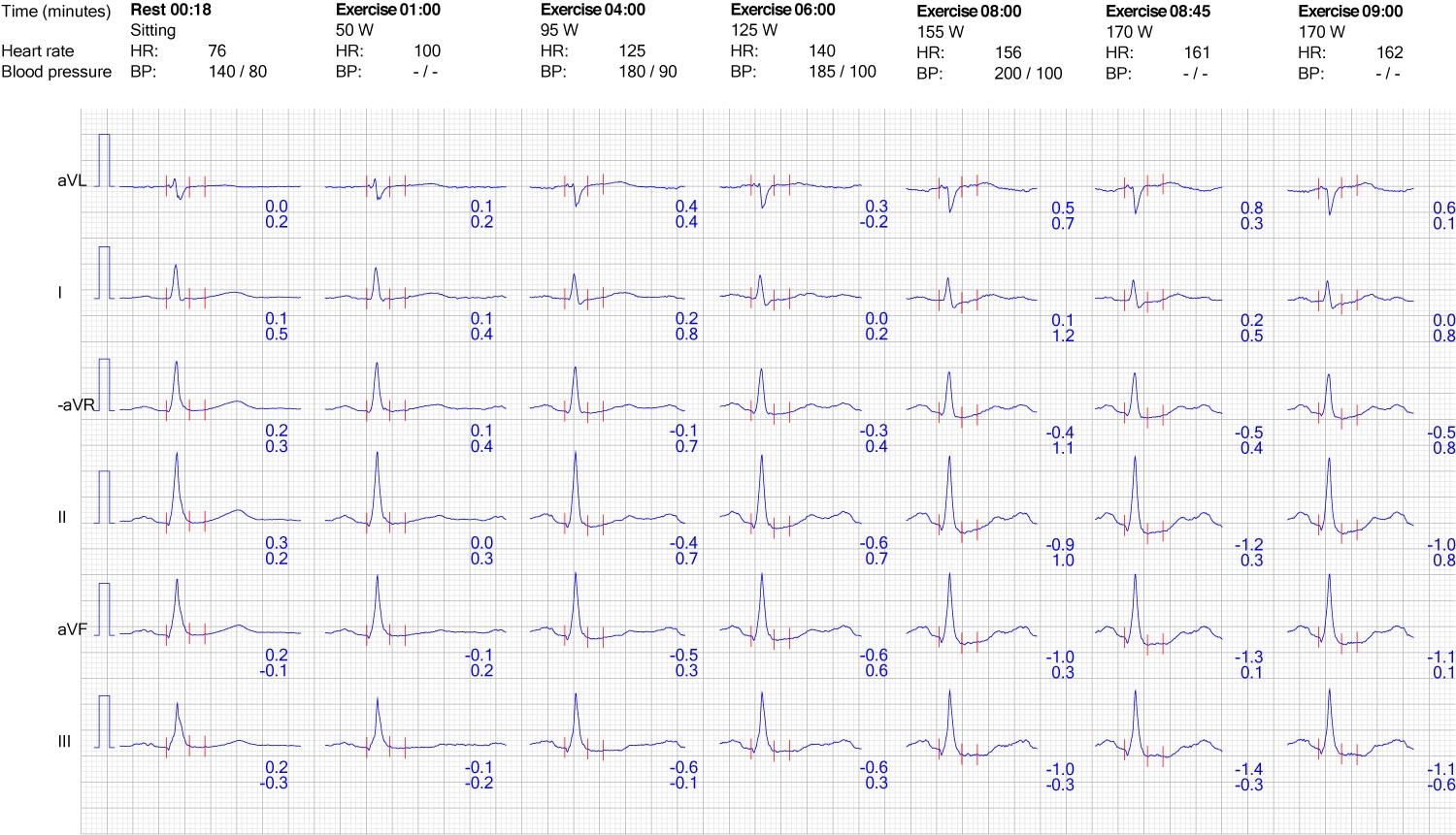 Stress Test Heart Rate Chart