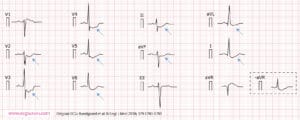 12-lead ECG (presented according to Cabrera), recorded at 63 years of age, demonstrates concave-upward ST-segment depression in leads I, II, aVL, aVF, and V2 through V6; and ST-segment elevation in lead aVR (which corresponds to an identical ST-segment depression in the inverted lead -aVR). A notch is evident in the ascending part of the ST segment.