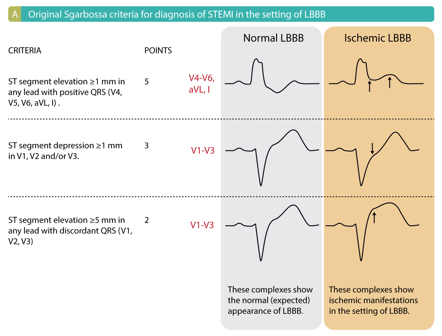 Left Bundle Branch Block LBBB In Acute Myocardial Infarction The 