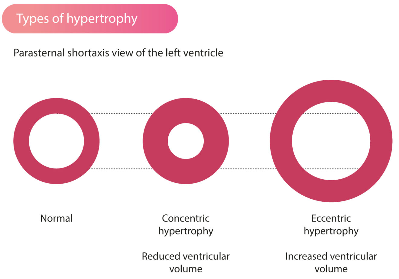 pathological hypertrophy definition pathological hypertrophy definition