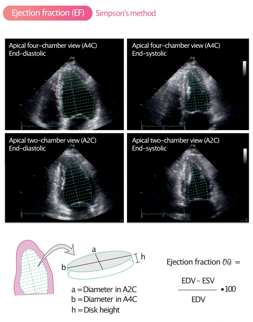 A SIMPLIFIED FORMULA FOR ESTIMATION OF EJECTION FRACTION FROM