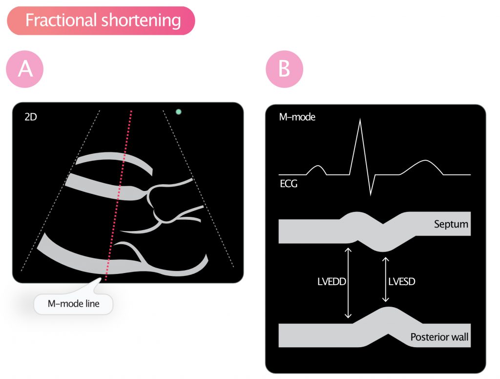 Figure 1. Calculation of fractional shortening.