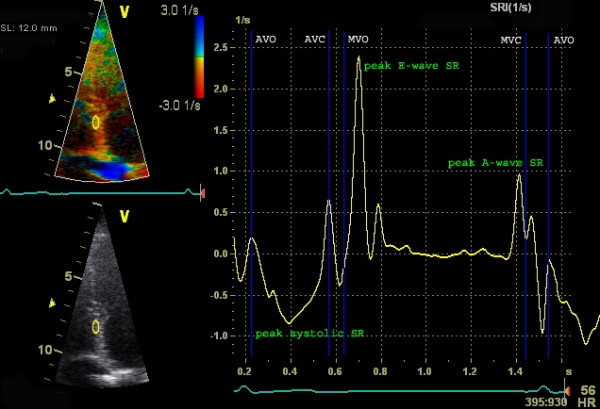 Strain, strain rate and speckle tracking: Myocardial deformation – ECG &  ECHO