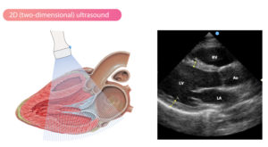 Two-dimensional (2D) echocardiography – The Cardiovascular
