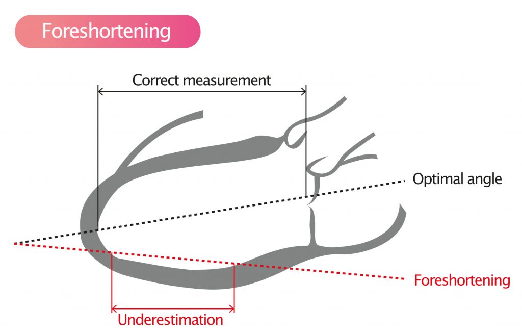 Figure 2. Foreshortening.