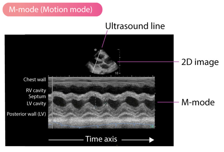 Mmode (motion mode) echocardiography Cardiovascular Education