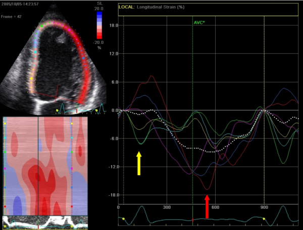 a Left ventricular global longitudinal strain curves of two