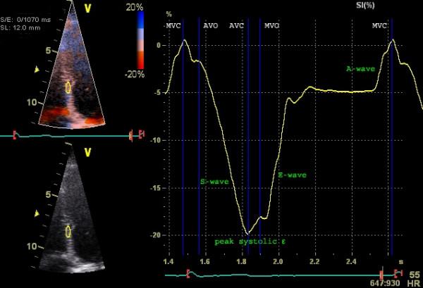 Post-systolic shortening is superior to global longitudinal strain